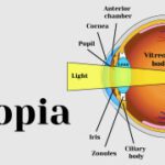 PresByopia-the-ulimate-guide